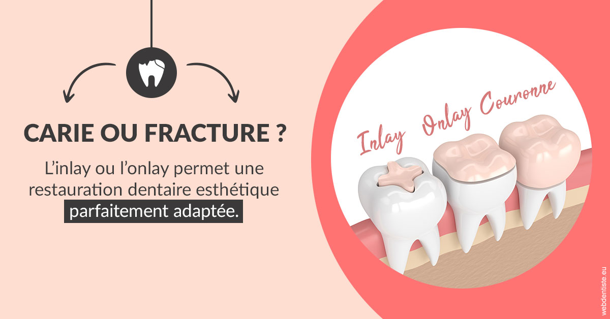 https://dr-claude-philippe.chirurgiens-dentistes.fr/T2 2023 - Carie ou fracture 2