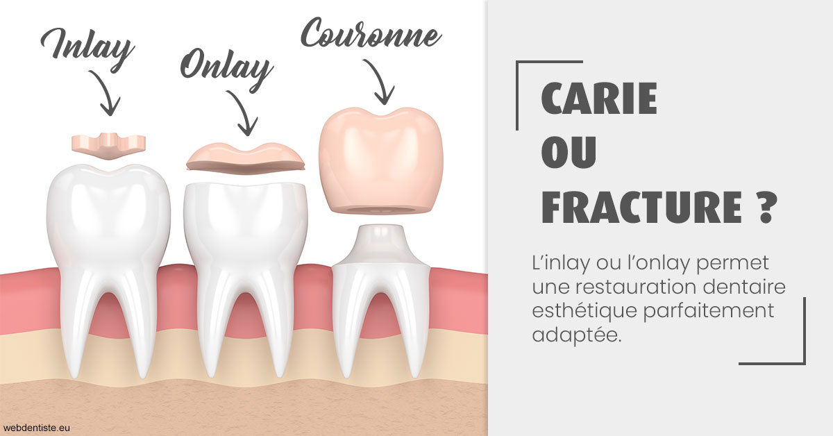https://dr-claude-philippe.chirurgiens-dentistes.fr/T2 2023 - Carie ou fracture 1