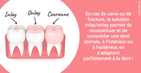 https://dr-claude-philippe.chirurgiens-dentistes.fr/L'INLAY ou l'ONLAY 2