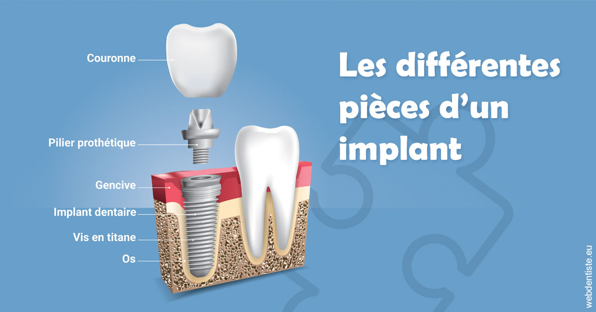 https://dr-claude-philippe.chirurgiens-dentistes.fr/Les différentes pièces d’un implant 1