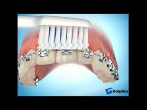 Brossage des dents avec un appareillage orthodontique